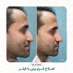 اصلاح فرم بینی بدون جراحی چگونه انجام میگیرد؟