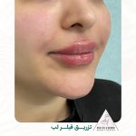 آیا تزریق ژل به لب عوارض دارد ؟