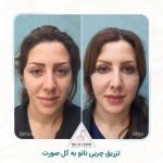 تزریق چربی بهتر است یا تزریق ژل؟