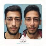 تزریق فیلر بینی