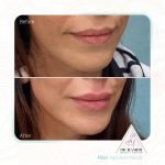 تزریق فیلر لب