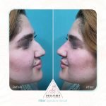 تزریق فیلر بینی