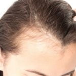 جلوگیری از ریزش مو – راهکارهای موثر در درمان ریزش مو