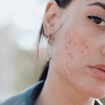 انواع جوش صورت و راهکارهایی معجزه آسا برای درمان آن