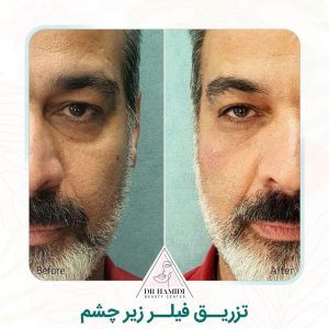 تزریق فیلر چشم رشت