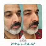 نمونه کار تزریق فیلر چشم رشت