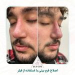 تزریق فیلر بینی رشت