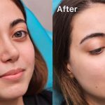 مراقبت های بعد از تزریق ژل