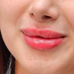 تزریق ژل لب طبیعی و نچرال در رشت