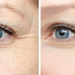 تزریق بوتاکس در خطوط پنجه کلاغی دور چشم