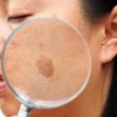 با کدام روش می توان از شر لک های پوست صورت رها شد؟