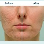 سابسیژن پوست چیست و چه کاربردی دارد؟